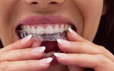 Invisalign North Hills: Clear Aligner Therapy for Discreet Orthodontic Correction